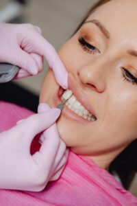 teeth bonding vs veneers