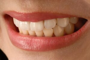 are veneers permanent