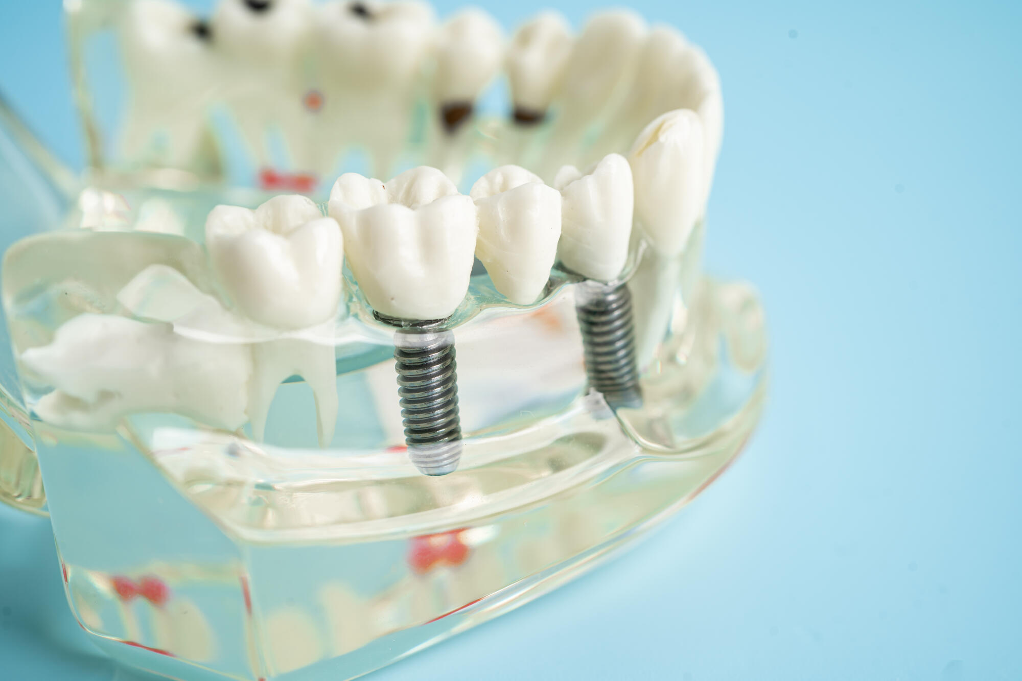 dental implants with bone loss
