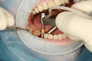 are dental implants painful
